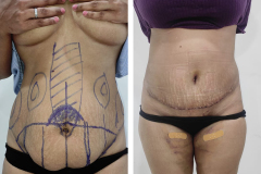ABDOMINOPLASTY - Case 2