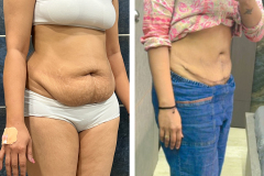 ABDOMINOPLASTY - Case 3