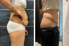 Abdominoplasty-3-2