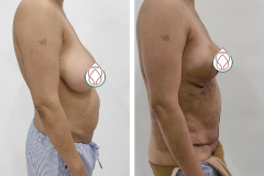 ABDOMINOPLASTY