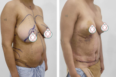 Abdominoplasty-3
