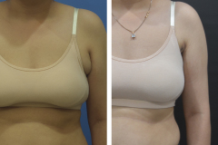 ACCESSORY BREAST