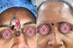 Basal-Cell-Carcinoma-Treatment
