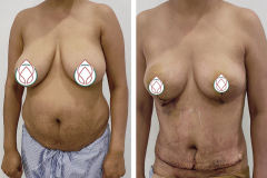 Breast-Reduction-Surgery-1