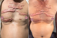 CHEST-WALL-KELOID