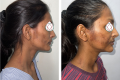 Facial-Fat-Grafting-1_