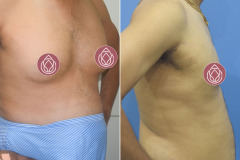 GYNECOMASTIA (CASE 3)