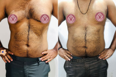 Gynaecomastia-2