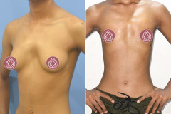 GYNECOMASTIA (CASE 6)