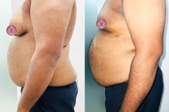 Gynaecomastia-3