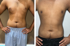 GYNECOMASTIA GRADE 2