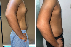 Gynecomastia-3-