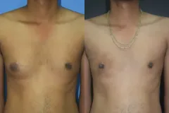 GYNECOMASTIA (CASE 1)