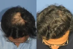 HAIR TRANSPLANT (CASE 2)