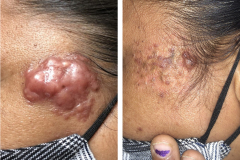 Keloid