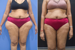 Liposuction