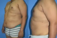 MALE ABDOMINOPLASTY (CASE 1)