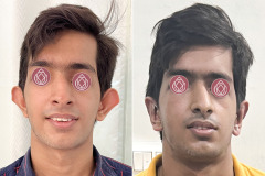 OTOPLASTY-SURGERY-CASE-1
