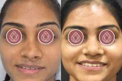 RHINOPLASTY-1-copy.jpg