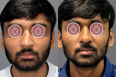 RHINOPLASTY-2-copy.jpg