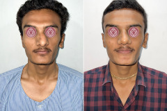 RHINOPLASTY (CASE 3)