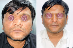 RHINOPLASTY-2