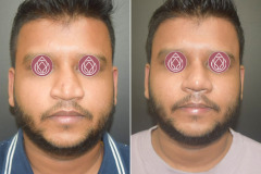 Rhinoplasty-2