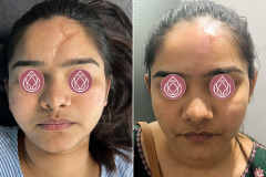 SCAR REVISION (CASE 1)