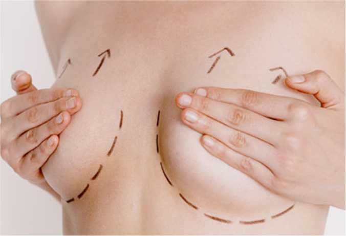 Breast Lift Surgery Benefits