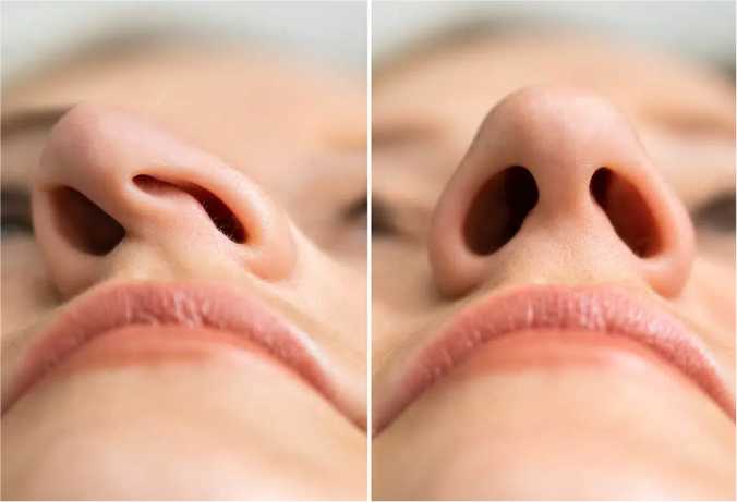 Benefits of Rhinoplasty