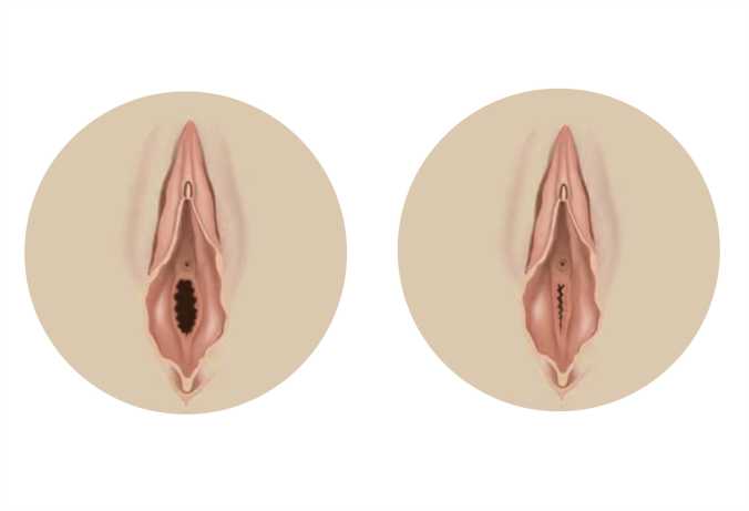 Benefits of Hymenoplasty