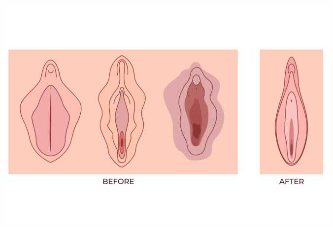 Benefits of Labia Reduction