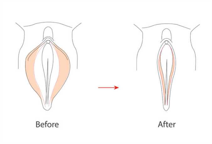 Benefits of Vaginal Tightening