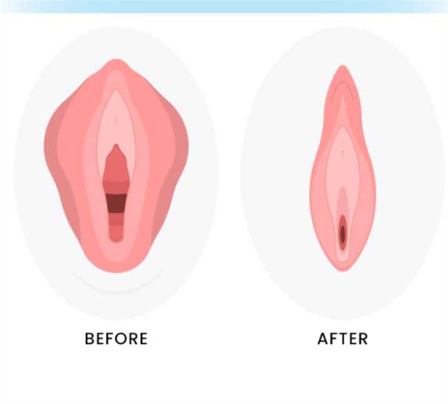 Ideal Candidates for Labia Reduction