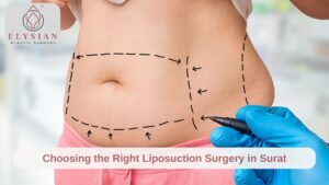 Best Liposuction Surgery in Surat