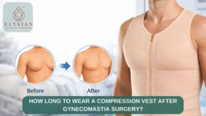 How Long to Wear a Compression Vest after Gynecomastia Surgery In Surat