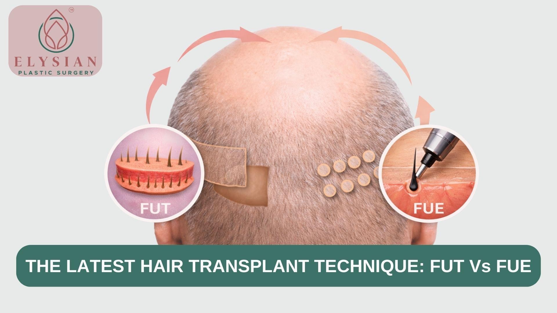 Latest Hair Transplant In Surat